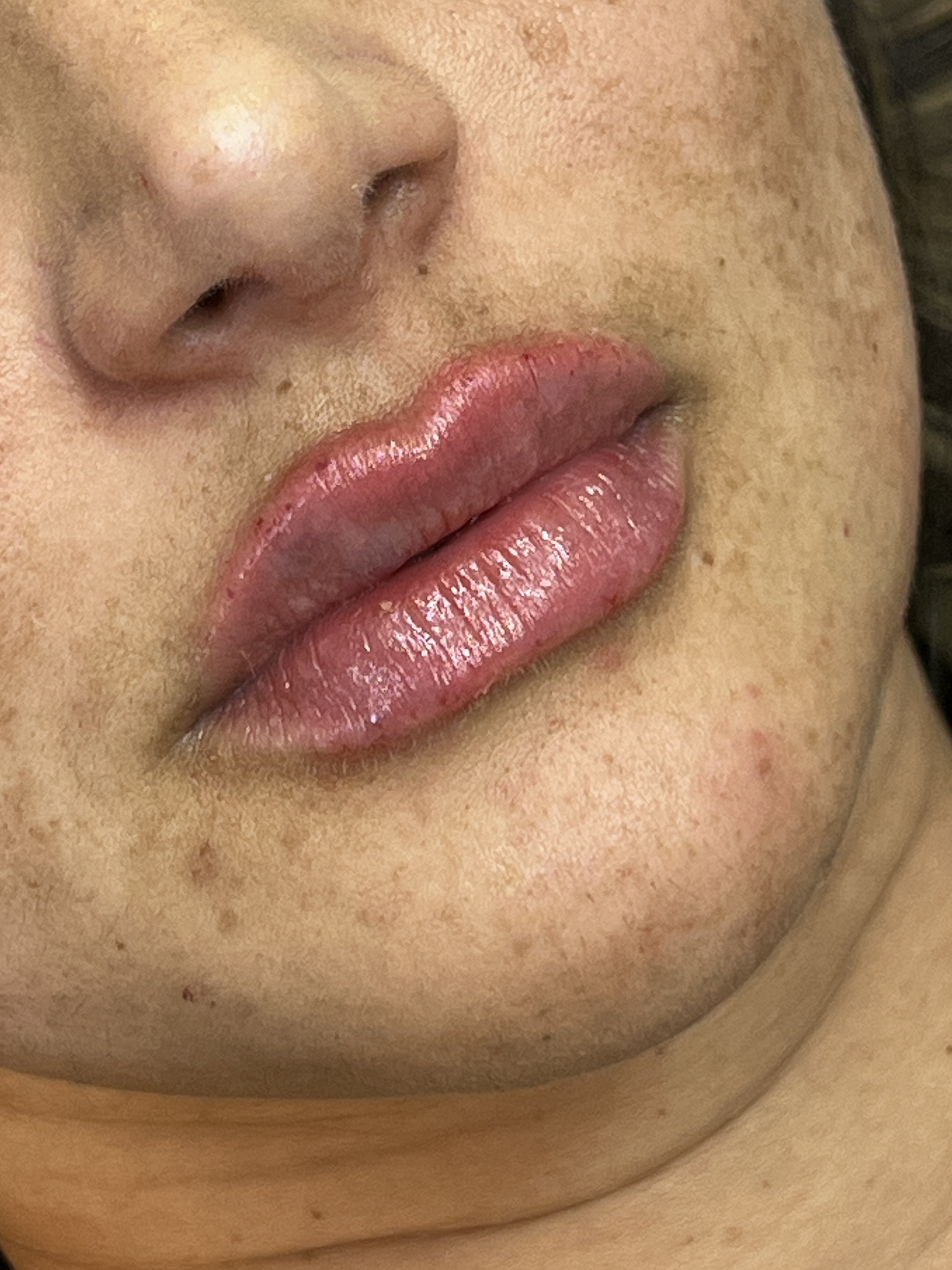 Cláudia logo após o preenchimento labial
